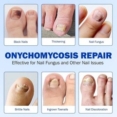Fungal Nail Patch Treatment Antifungal Toenail & Fingernail Solution 20 Patches