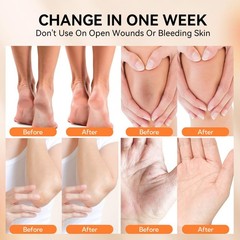 LANBENA Urea Cream 40 Percent For Feet Plus 2% 3.52 Ounce (Pack of 1), orange