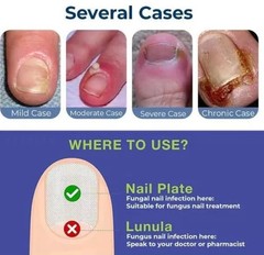 Nozti Anti Paronychia Relief Oil, 10ml, Natural Nail Treatment for Pain Relief