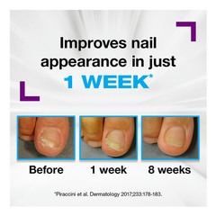 EMTRIX Fungal Nail Repair Treatment Clinically Proven in 1 week – 10ml