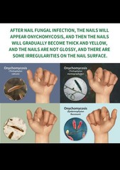 7 Days Nail Fungus Treatment Serum Repairs Damage Nail & Cuticle Skin Care-1oz