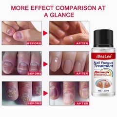 iBeaLee Nail Fungus Treatment 7DAYS Extra Strong Repair Essence Serum for Nails