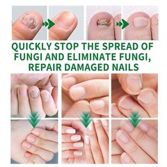 Nutraboost Nail Fungus Treatment Gel, Nail Fungus, Fungus Cream NEW 2026