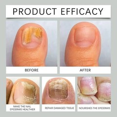 Nail Fungus Brightening Nourishing Nail Appearance Anti-fungal Nail Care Liquid