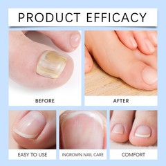 `Nail Fungus Treatment Cream, Nail Repair Cream Gentle Non-Sticky Care Lotion