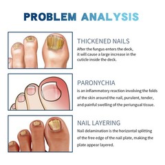 Nail Care Pen, 4~20Pcs Fungal Nail Pen, Nail Fungus Treatment For Toenail US