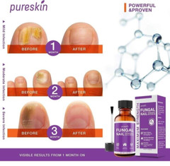Pureskin Fungal Nail Toenail Renewal 50ml Toe Finger Nail Health Support New