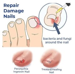 Nozti Anti Paronychia Relief Oil, 10ml, Natural Nail Treatment for Pain Relief