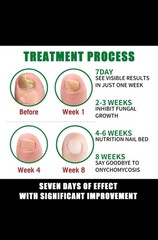 7 Days Nail Fungus Treatment Serum Repairs Damage Nail & Cuticle Skin Care-1oz