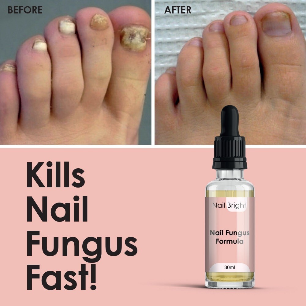 NAIL BRIGHT Serume 30ml (KILLS NAIL FUNGUS STOP BACTERIA TOE)