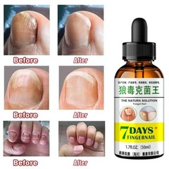 Natural Solution Fungal Nail Essence Serum Care Repair Foot Nail GET 1 FREE