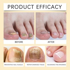 Nail Care Patch ntle Care Soft Nail Toenail Night Daily Care