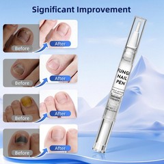 Toenail Fungus Pen with 25% Undecylenic Acid 1 Fl Oz (Pack of 1), transparent