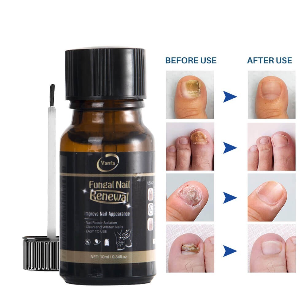 Vanfa Fungus Nail Treatment Extra Strength for toenails Fungal Renewal 0.34 Floz