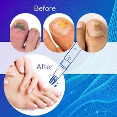 Fungal Nail Pen, Toenail Fungus fungus 0.1 Fl Oz (Pack of 3), Blue