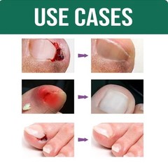 Nozti Anti Paronychia Relief Oil, 10ml, Natural Nail Treatment for Pain Relief