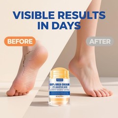 ZyraGloz Urea Cream Stick 60% plus Salicylic Acid 2%, 1.4 Ounce (Pack of 1)