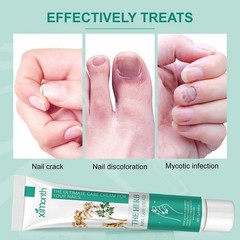 Nail Repair Cream Fungal Toenail Treatment Thickened Soft Nail Ingrown Care