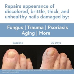 Tolvere Nail Renewal Solution, Rapidly Improve Appearance of Discolored,…