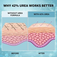 42% Urea Cream PLUS With 2% Salicylic Acid | High 4 Ounce (Pack of 1), BLUE