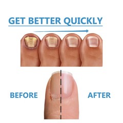 Tea Tree Nail Repair Patch Natural Nail Care & Strengthening for Toenail