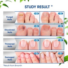 Maximum Strength Toenail Fungus Treatment with 0.5 Fl Oz (Pack of 2), Black