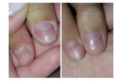 🌿Natural Ingredients OniStop Oil For Nail &Nail Skin Care Treatment Onycholysis