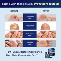 Toenail Fungus Treatment with 25% Undecylenic Acid, Toe Black