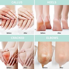 Urea Cream 20 Percent For Feet Plus 2% Salicylic 5.29 Ounce (Pack of 1), 20%