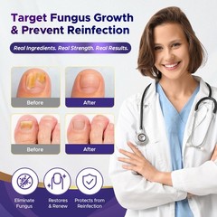 Toenail Fungus Treatment : Extra Strength 25% 0.51 Fl Oz (Pack of 2), Black