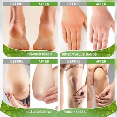 Ultrove Urea Cream 42% – 2% Salicylic Acid Foot 3.5 Ounce (Pack of 1)