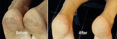ProLinc Be Natural Callus Eliminator Foot Treatment 4oz – #1 Best Callus Remover