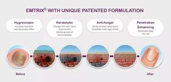 EMTRIX 10ml Anti-Fungal Nail Treatment Toenail Fungus Care Solution Healthy nail