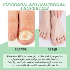 Nutraboost Nail Fungus Treatment Gel, Nail Fungus, Fungus Cream NEW 2026