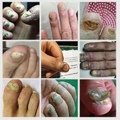 Extra Strong Nail Fungus Treatment Serum Essence Oil Feet Nails Repair Care Esse