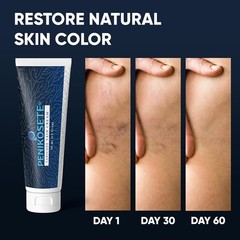 Varicose & Spider Vein Cream for Men & Women | Ayurvedic Ashwagandha Formula for