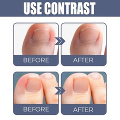 Nail Daily Care Oil for Ingrown Toenails on Hands Feet Toenails Anti Fungal