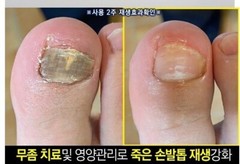 LIGHT PDT nail regeneration supplement 5ml / Made in Korea