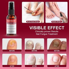 Toenail Fungus Treatment, Treatment Extra Strength with 1 Fl Oz (Pack of 5)