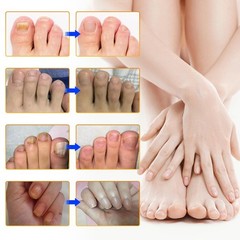 64 Pcs Fungal Nail Patches – Extra Strength Toenail Fungus Treatment Overnight