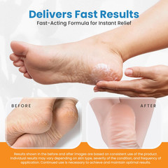 Revitaderm 4D Urea Cream 40 Percent for Feet Maximum 4 Ounce (Pack of 1)