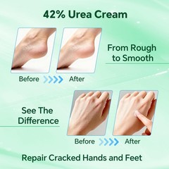 Professional 42% Urea Cream for Feet, Intense 5.29 Ounce (Pack of 1)