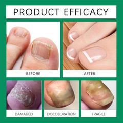 Anti Nail Stick Fungal Shield Anti 1-3PCS Stick Roll On 10ml Fungal Nailshield