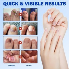 Fungal Nail Patch Treatment Antifungal Toenail & Fingernail Solution 20 Patches