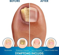 FUNGAL NAIL TREATMENT Peel-Away Technology: Brightening & Smoothing Nail Repair