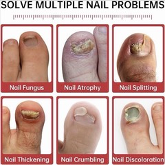 QQE Fungal Nail Treatment 7 Days+ Cream 1% Tolnaftate 0.51 fl oz / 15 ml