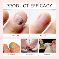 6X Ultragrow Nail Serum Nail Growth Serum for Brittle Peeling Breaking Thin Nail