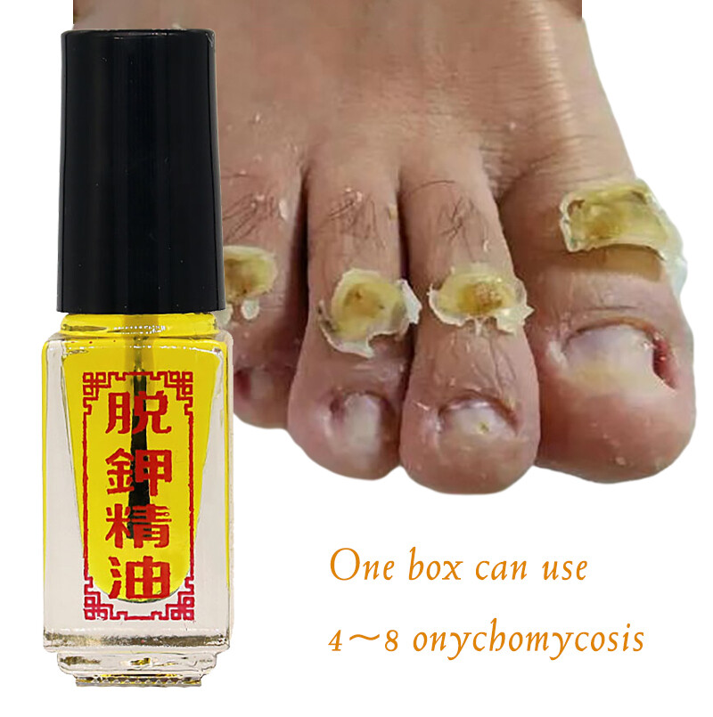 Nail Removal Essential Oil Anti-Fungus Oil Removal of Onychomycosis Paronychia