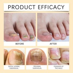 Onychomycosis Care Solution Pen Gently Repairs Strengthens and Thickens Nail 3ML