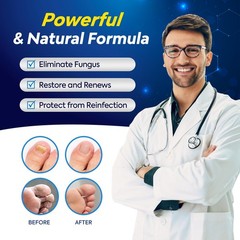 Toenail Fungus Treatment with 25% Undecylenic Acid, Toe Black